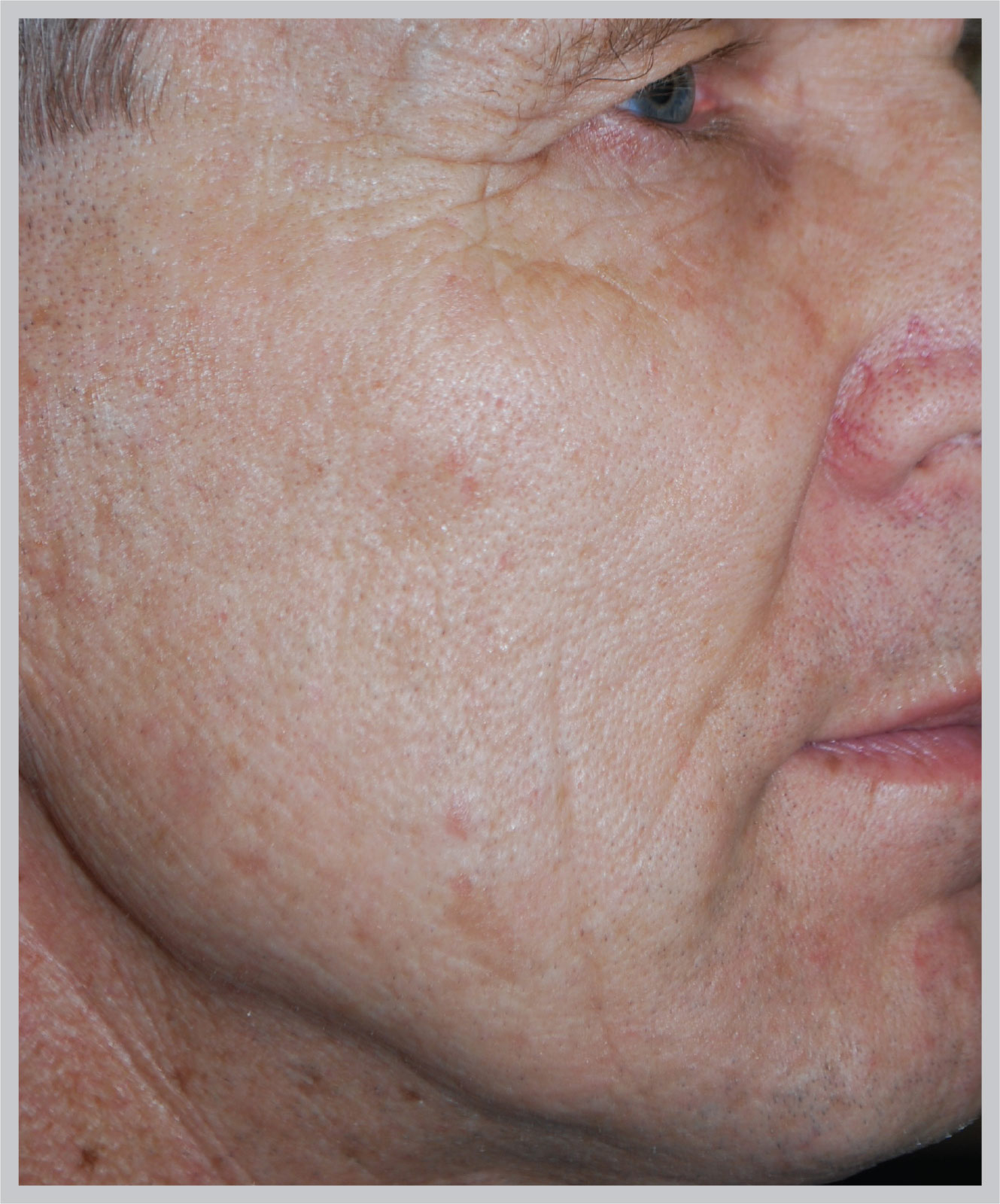 Laser Skin Rejuvenation in Auburn Hills, MI | Oakland Hills Dermatology