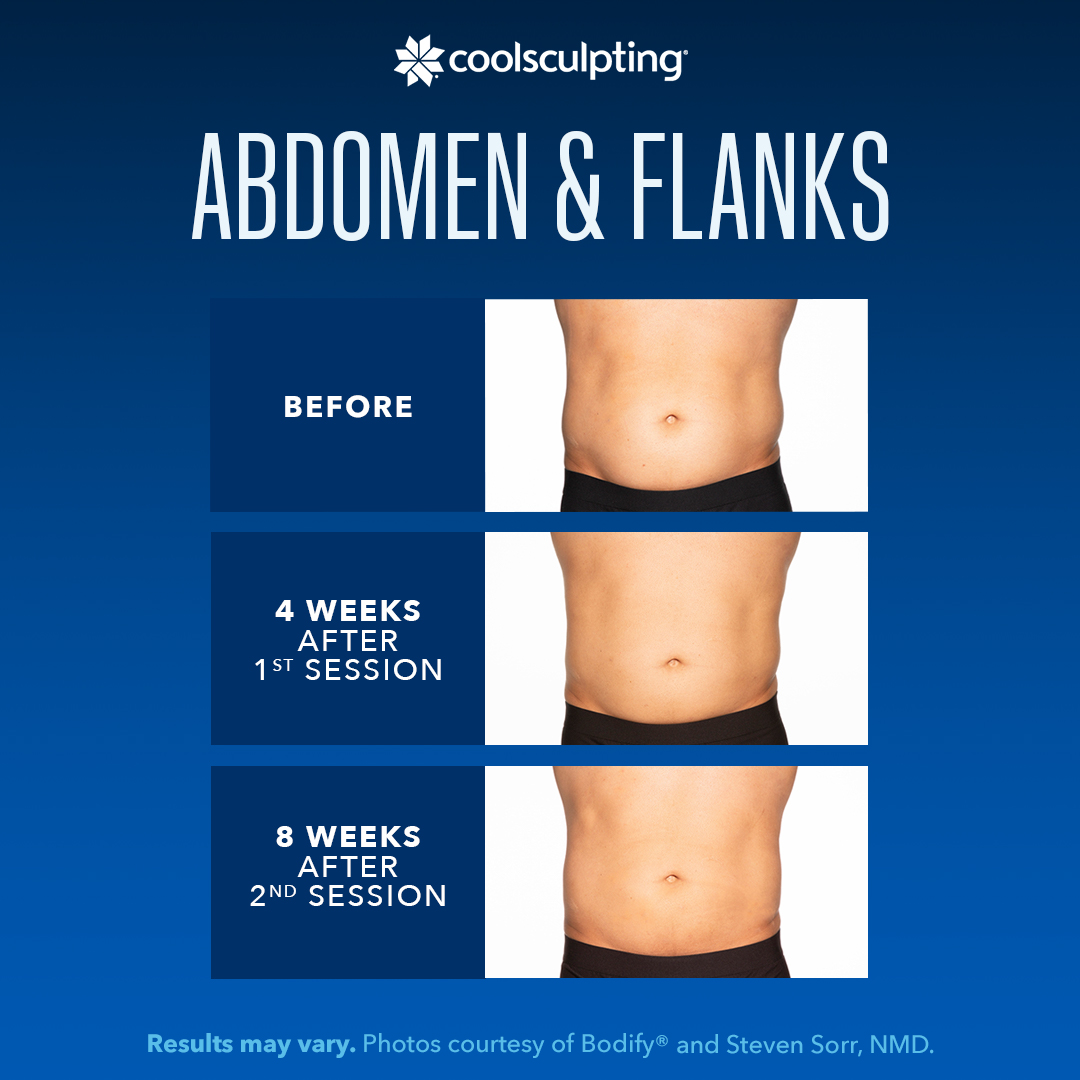 CoolSculpting - Flanks and Bra Strap Area Before & After Gallery