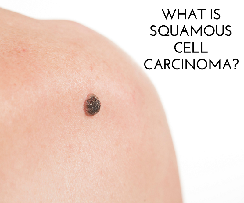 What is Squamous Cell Carcinoma? | Oakland Hills Dermatology