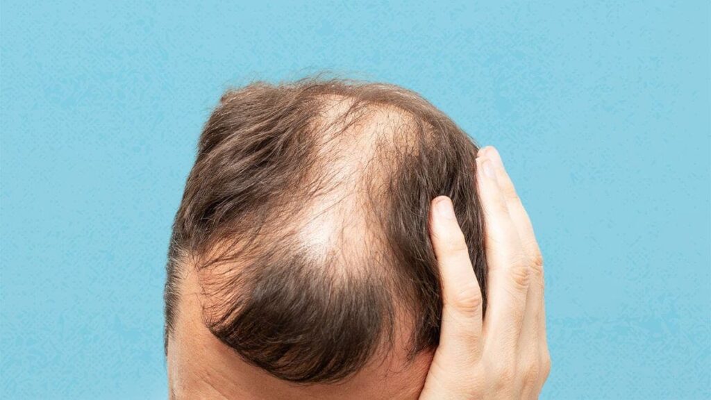 What is Androgenetic Alopecia