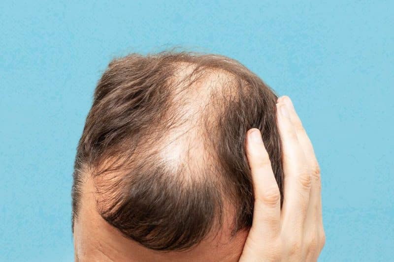 What is Androgenetic Alopecia