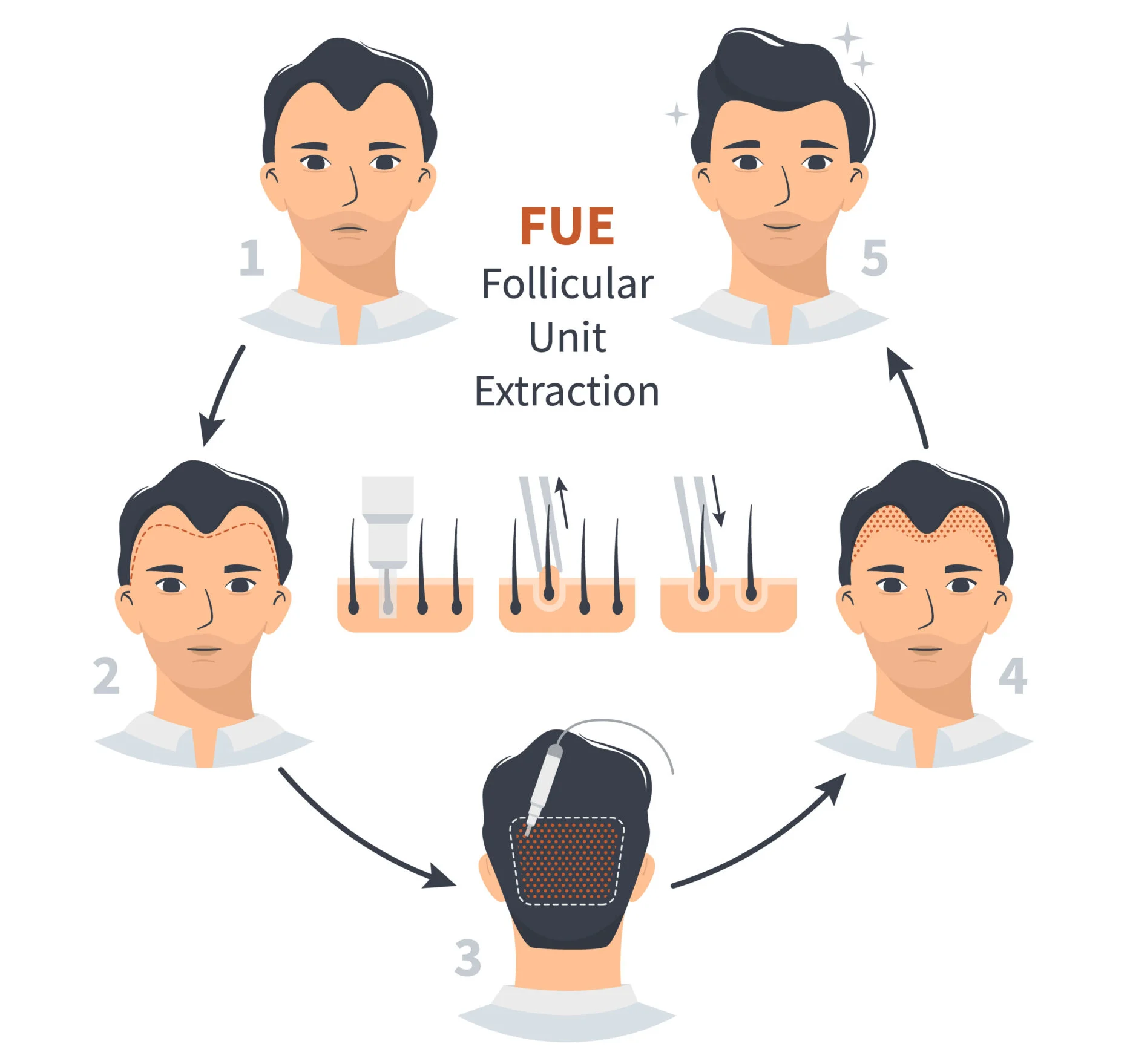 Hair Transplant Process
