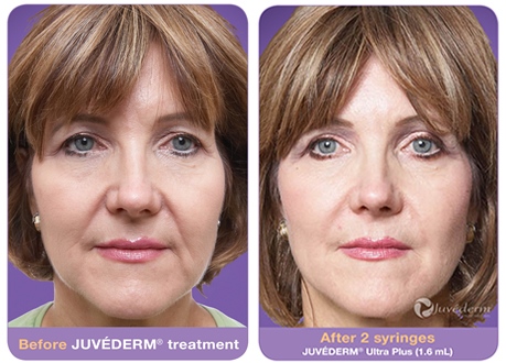 juvederm-before-after1