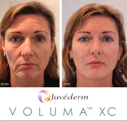 juvederm-voluma-before-and-after-pictures